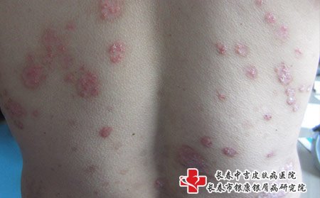 松原哪家医院治疗牛皮癣更好