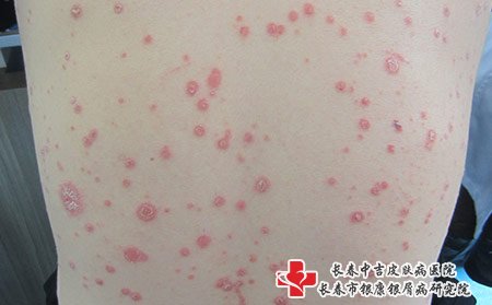 松原哪家医院可以治疗牛皮癣