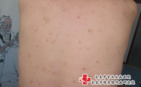 松原哪家医院看牛皮癣好