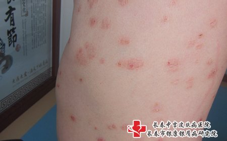松原哪家医院看牛皮癣专业