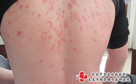 松原哪家医院的看牛皮癣专业