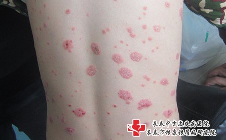 松原哪家牛皮癣医院比较好