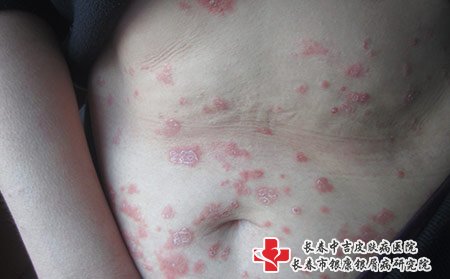 松原哪家牛皮癣好
