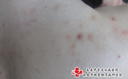 治牛皮癣白城哪家医院更好