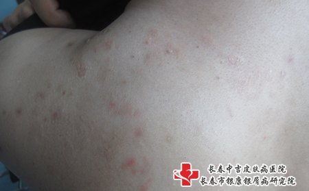 在白城专治牛皮癣不错的医院