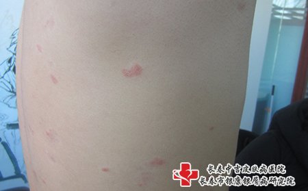 在白城专业牛皮癣医院哪所效果好