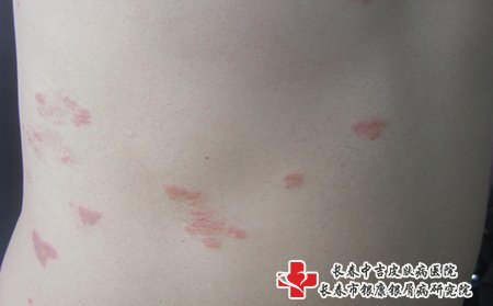 在白城治牛皮癣哪所医院好