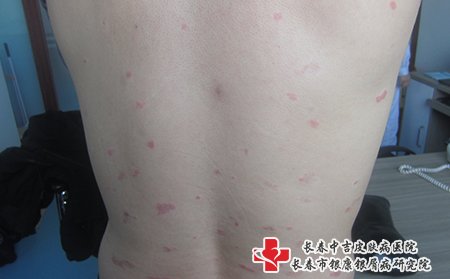 在白城治疗牛皮癣哪所医院好
