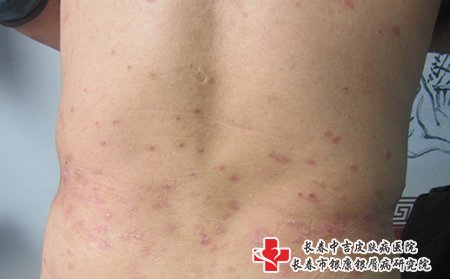 在白城治疗牛皮癣哪个医院效果好