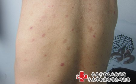 在白城好的牛皮癣医院联系方式
