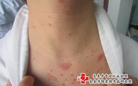 牛皮癣在白城上哪家医院治疗好