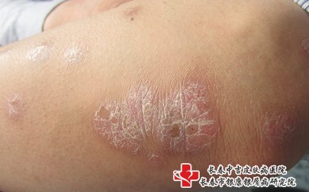 在白山看牛皮癣哪个医院专业