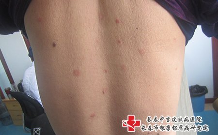 在白山治疗牛皮癣专业的医院