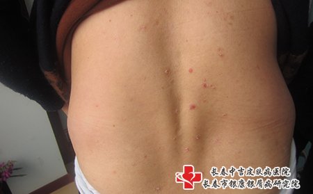 治疗牛皮癣白山哪家好