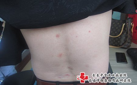 治疗牛皮癣白山哪个医院好