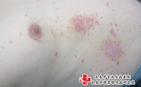 在白山哪里的医院看牛皮癣好