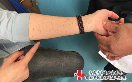 牛皮癣医生陈辉挂号费多少钱