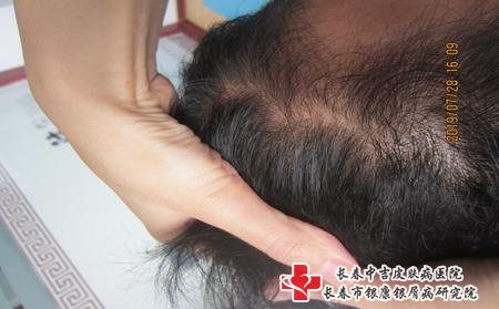 牛皮癣医生陈辉挂号费多少