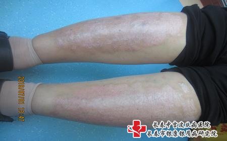 牛皮癣主任陈辉