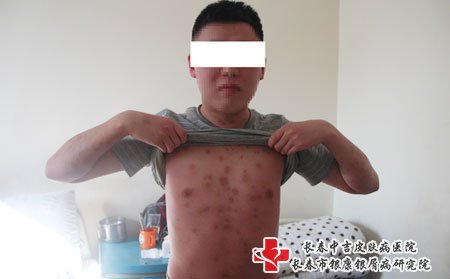 牛皮癣护理常识