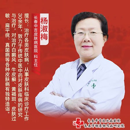长春市中吉牛皮癣医院杨淑梅主任