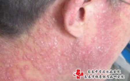 红皮型牛皮癣