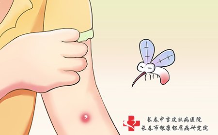 牛皮癣