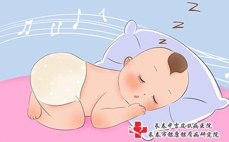 脓包型牛皮癣