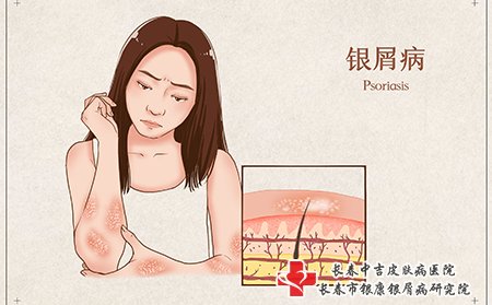 牛皮癣