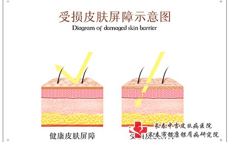 牛皮癣