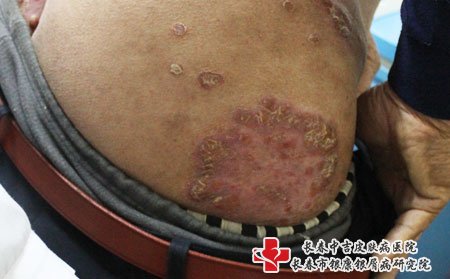 牛皮癣