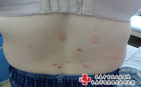 牛皮癣治疗可以选择药物治疗，和物理治疗