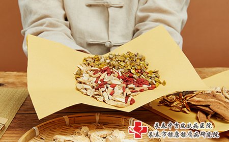 点滴状牛皮癣可以用中药药浴，物理治疗等方式