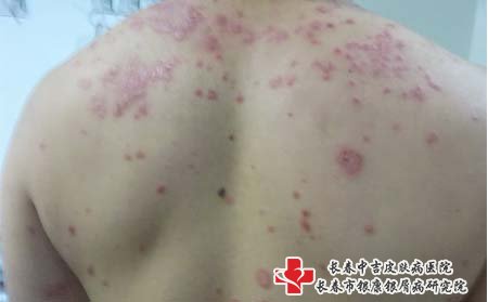 牛皮癣减少复发就要做好预防，像不良习惯需要戒掉