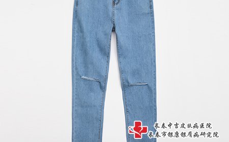 牛皮癣患者尽量少穿牛仔裤，不透气