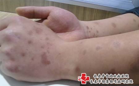 牛皮癣关节炎要做好护理