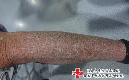 点滴状牛皮癣只要积极治疗是可以好的