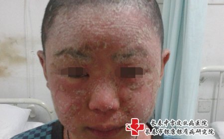 牛皮癣患者要注意饮食清淡