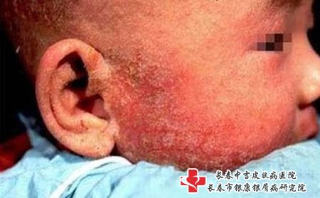 儿童牛皮癣要注意治疗方式