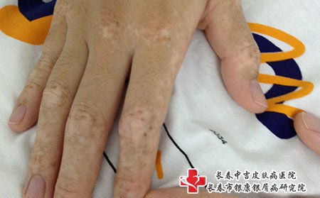 这是白癜风图片