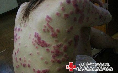 牛皮癣患者选择医院要看医院名气