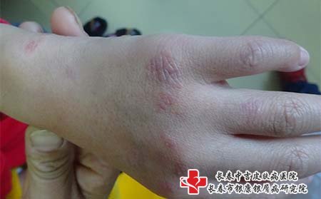牛皮癣关节炎症状,关节型牛皮癣症状