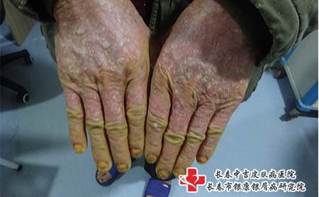 关节型牛皮癣照片