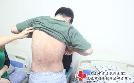 发痒是寻常型牛皮癣的症状特征