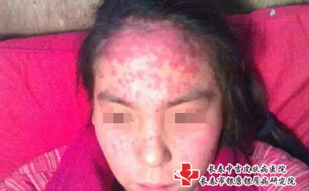 面部牛皮癣可以用中药治疗