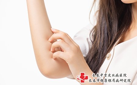 牛皮癣晚上痒,不要使劲抓挠
