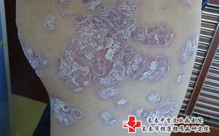 男性牛皮癣怎么办,男性有牛皮癣怎么办
