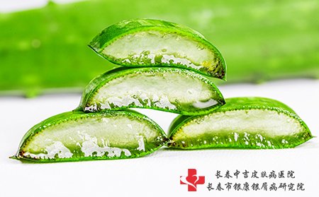 芦荟胶可以治疗牛皮癣