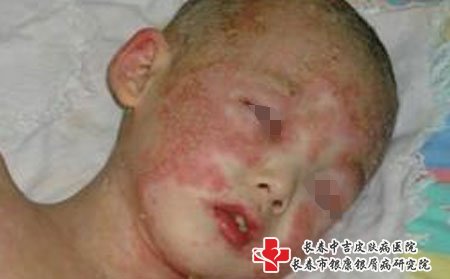 儿童牛皮癣要注意正确治疗