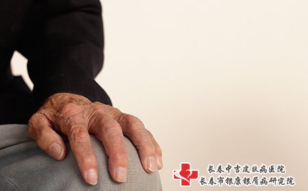 老年牛皮癣要注意护理